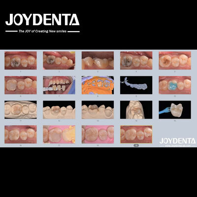 comprar Adultos Crianças Inlaçamento Dental Cerâmico de Porcelana Restaurador para Dentes Danados fabricação em linha