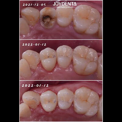 comprar Porcelana Dental de Ajuste Precise Inlay Restauração de Dentes Danados para Adultos e Crianças fabricação em linha