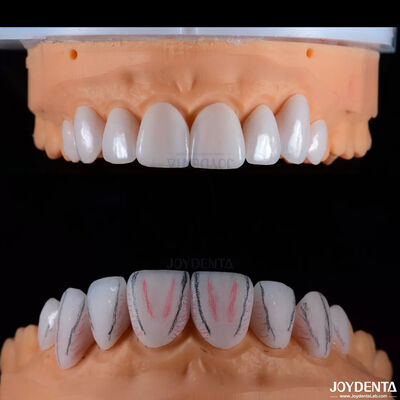 comprar Veneers de cerâmica dental Emax feitos sob medida com alto brilho resistente a manchas fabricação em linha