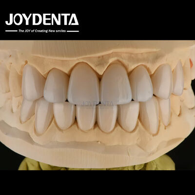 comprar 0.3-0.5mm espessura Feldspathic Porcelana Veneer Alta resistência à fratura Upgrade seu sorriso fabricação em linha