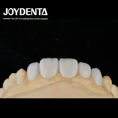 comprar Materiais de porcelana de personalização Emax Veneers de dentes para ligação de alta estética fabricação em linha