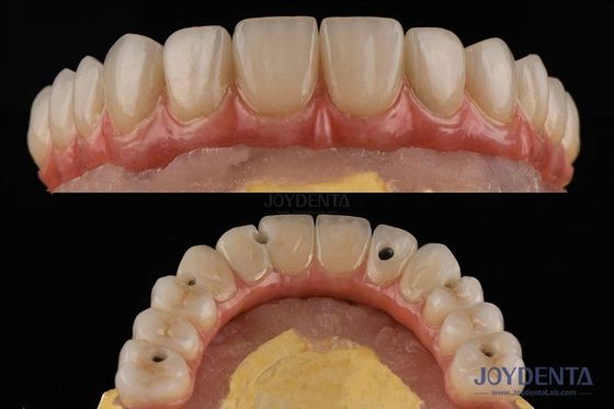 Plataforma de implante dentário de superfície áspera Pontes dentárias com conexão interna