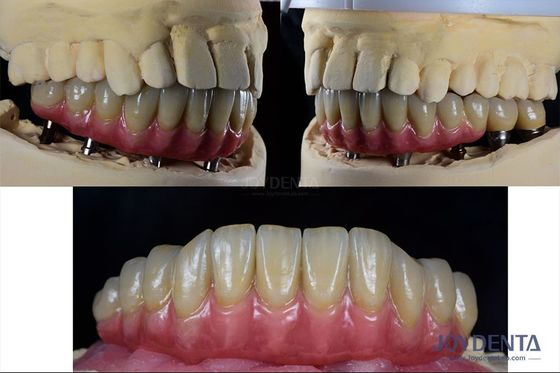 Reconstrução dentária Implante dentário múltiplo Titânio Conexão protética interna