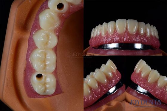Implantes dentários múltiplos de titânio Dentes Implantes internos resistentes a rachaduras personalizados