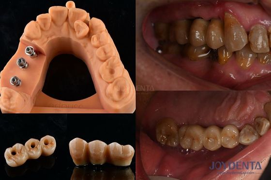 Ultra dura estabilidade da cor Implante Dental coroa OEM fácil manutenção duradoura