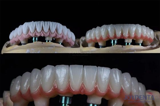10 mm Dentes Múltiples Kit de Implante Dental de Dois Estágios para coroa próteses endosséticas