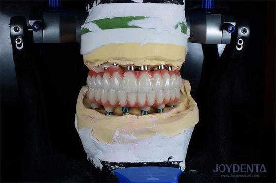 Implante de Dente Único de 10 mm de comprimento, irradiado com Gamma para resultados cirúrgicos ótimos.
