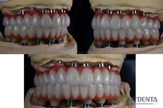 Implante de Dentes Múltiplos de Titânio de 10 mm Superfície áspera para restauração dental