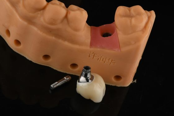 Implantes Dentários Pré-dentes de prata cilíndrica de precisão