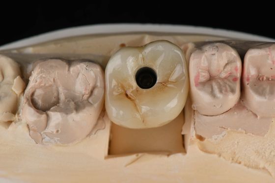 Titânio 10mm Dentes únicos Implantes Dentários Substituição Abutment Auto-Tapagem
