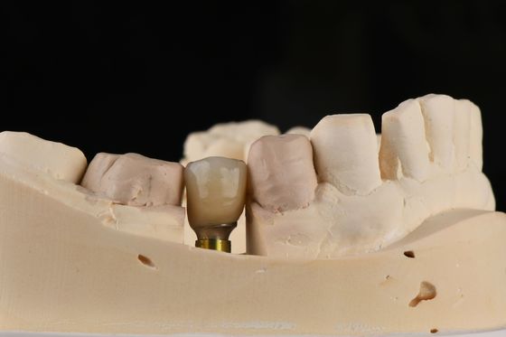Implante de dente único em areia com fio de auto-toque e conexão hexadecimal interna