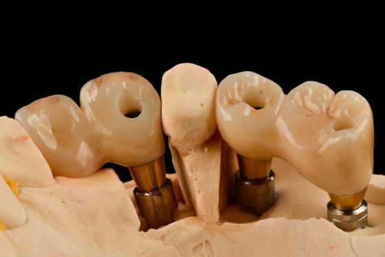 Implante Dental de Titânio de 3,0 mm com Funcionalidade Otimizada