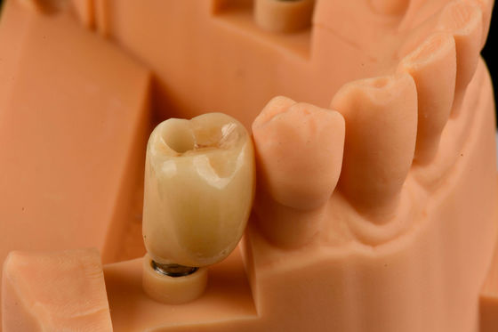 Conexão hexadecimal interna Implantes dentais de titânio revestidos de areia Substituição de um único dente