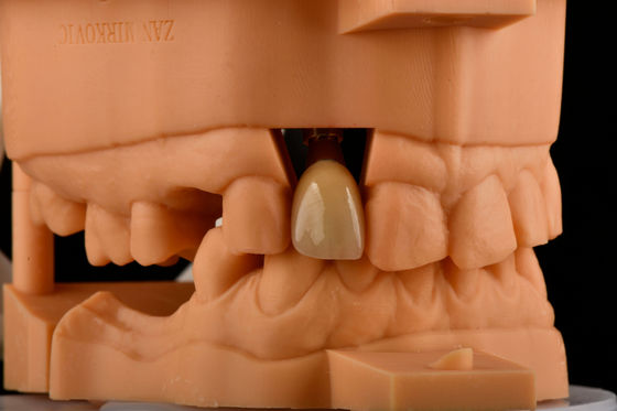 Hex Interno 3,0 mm Profundidade 1,5 mm Pitch Implante Dental de Titânio Único Substituição