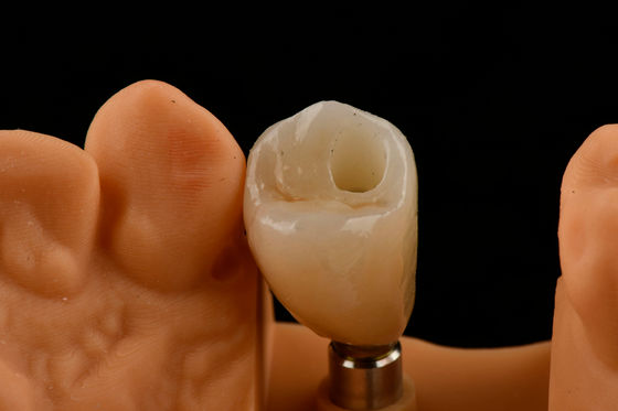 Implantes dentários de dente único de titânio Tipo de conexão hexadecimal interna para ajuste ideal