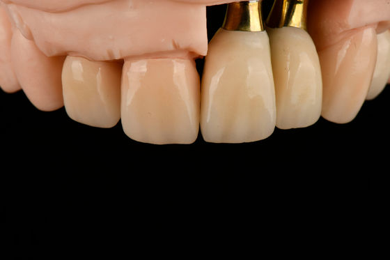 Implante de substituição de dente único de titânio com esterilização por irradiação gama