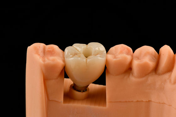Implantes Dentários de Titânio de 10 mm
