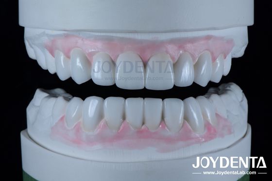 Restaurações dentárias de alta precisão de cera em odontologia 1-2 mm de espessura