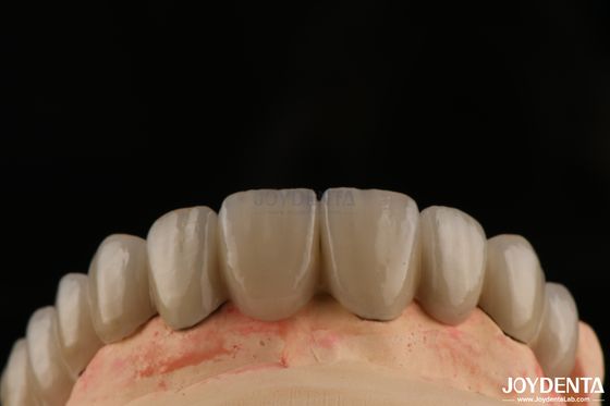 Porcelana PFM fundida a coroas e pontes metálicas