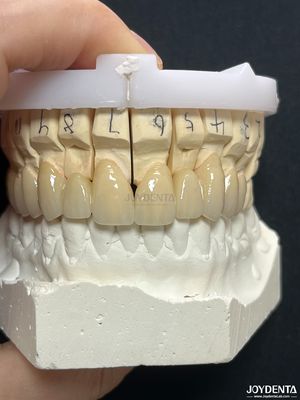 Coroa de metal fundido de porcelana PFM sem costura para restauração biocompativel a longo prazo