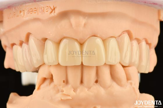 Biocompativel PMMA M75 Resistente a arranhões de restauração para estética dentária
