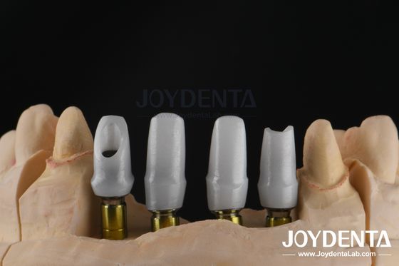 Implante dentário personalizado de zircônia para restaurações de unidade única ou múltipla