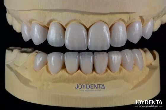 Finete de cerâmica avançada Biocompativel para um sorriso natural