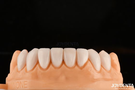 Forte ligação com esmalte dentário para uma adequada e segura veneers dentárias personalização para tons personalizados para combinar dentes naturais