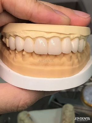 Tons personalizados para combinar com os dentes naturais Biocompativeis e resistentes a manchas Veneers dentários