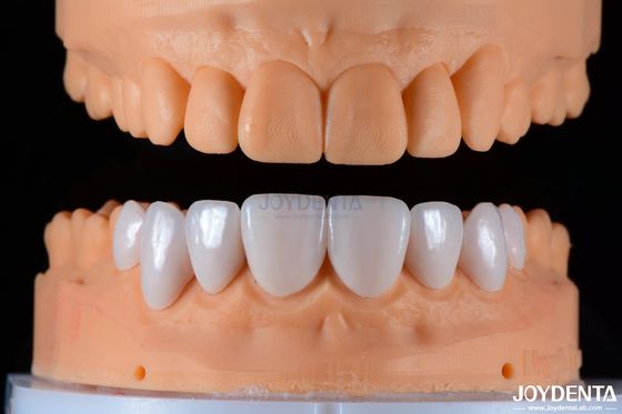 Finéris de porcelana seguras, cerâmica e estética natural com forte adesão