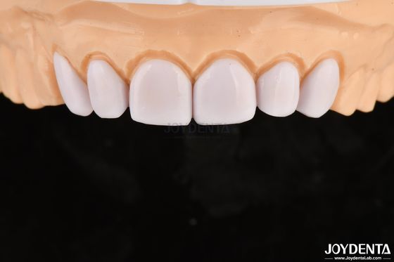 Folheados dentários para dentes desalinhados Biocompatibilidade e suavidade nos tecidos orais
