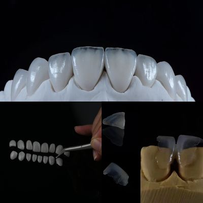 Finê de vidro cerâmico: obtenha um sorriso de aparência natural com esta solução dentária superior