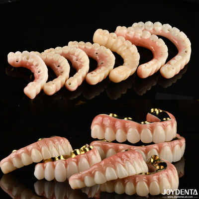 Implante de coroa e ponte - A escolha confiável e comprovada para a reconstrução dentária