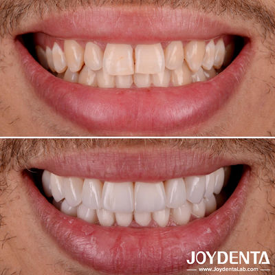 Perfeito Apto Veneers Dentes de Porcelana Transparência Natural Veneers Dental Laminado