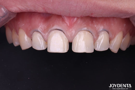 Veneers de porcelana dentária de aparência real perfeitamente adequado Veneers de cerâmica para dentes da frente