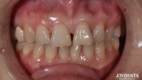 0.5mm Espessura Cerâmica Veneers Dentários Natural Procurando Dentes Anteriores Indicação