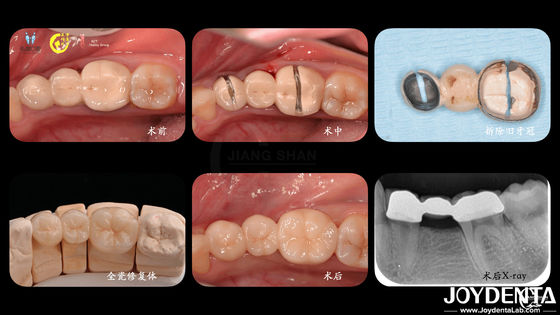 Coroa dentária de zircônio adaptada Biocompatibilidade Conforto Personalização para uma experiência ideal do paciente