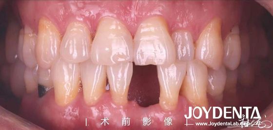 Ponte de resina de Maryland para dentes anteriores e pré-molares
