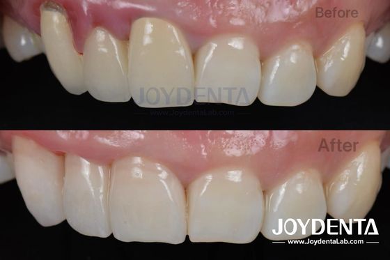 Procedimento indolor BOPT Técnica dentária para preparação precisa dos dentes