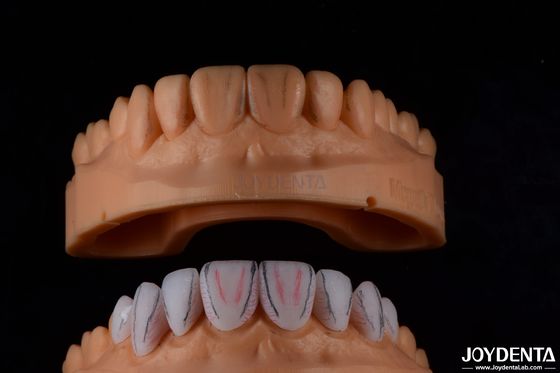 Veneers de cerâmica dental Emax feitos sob medida com alto brilho resistente a manchas