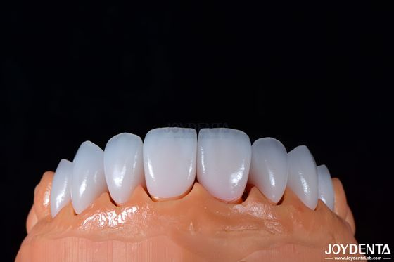 0.3-0.5mm Espessura Emax Veneer de porcelana para dentária cosmética de alto brilho