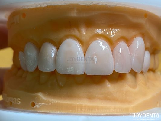 Alta permeabilidade Veneers de aparência natural Veneers de porcelana Emax personalizado
