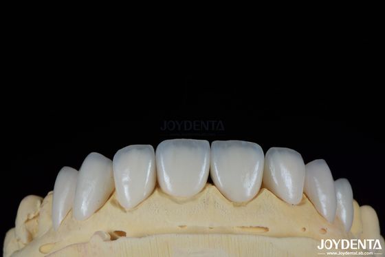 Texturas de superfície brilhantes Veneer feldspático de aparência natural Veneer de porcelana