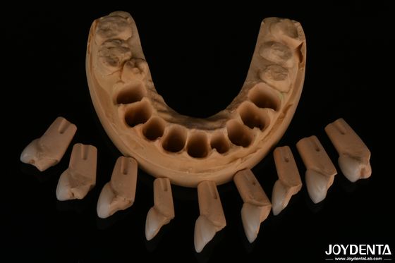 Finete dental feldspático de ajuste preciso altamente natural com textura de superfície brilhante