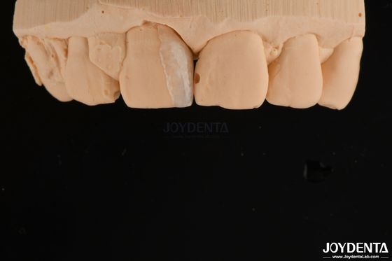 Microfoneiras de casca fina Tratamento dental cosmético Microfoneiras de dentes finas