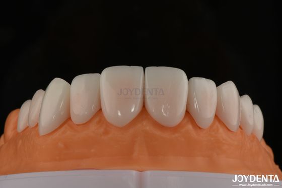 A1-A4 Ips Emax Prensa de porcelana Folheados dentários resistentes a manchas Forma personalizável