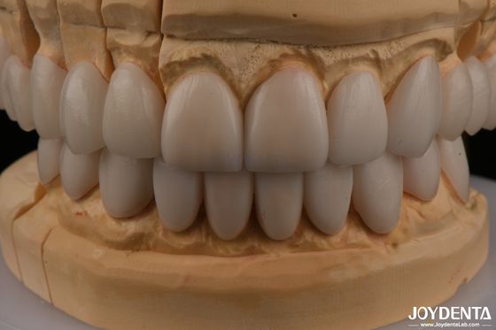 0.3mm Espessura Ips Emax Veneers Veneers Cerâmicas Anterior Restaurações Posteriores