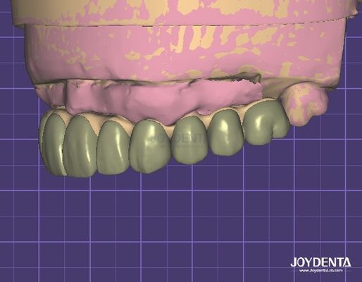Segurança de dados compatível com a HIPAA Modelo 3D de cera digital para modificações dentárias
