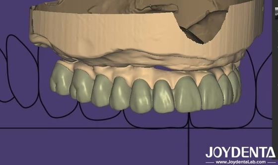 Desenho individualizado Diagnóstico Digital Wax Up Laboratório Software Integração perfeita