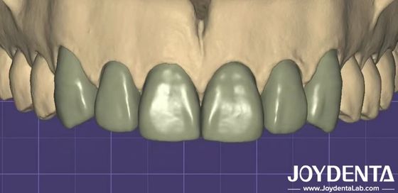 Impressão 3D Virtual Digital Wax Up Compatibilidade perfeita com outros softwares dentários